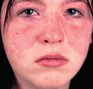 مرض الذئبة الحمراء وأعراضه والوقاية منه