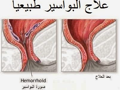 كيفية علاج البواسير في المنزل