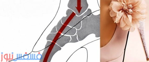 أضرار الكعب العالي علي صحتك شاهديها 10 أضرار الكعب العالي علي صحتك