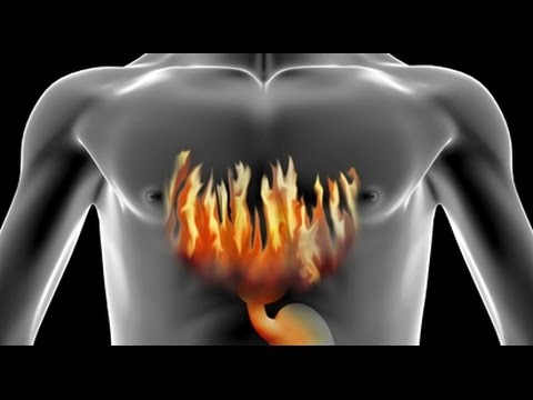 كيف تعالج نفسك من حموضة المعدة