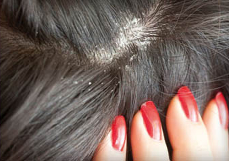 كيفية التخلص من قشرة الشعر المزعجة 10 التخلص من قشرة الشعر