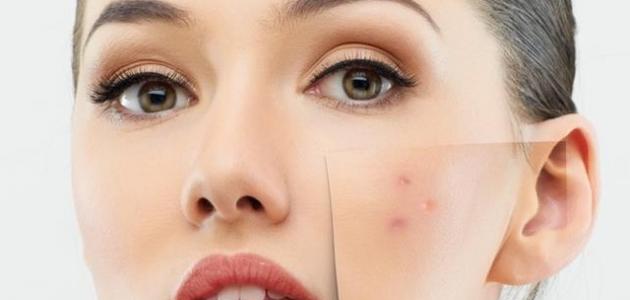 طرق التخلص من حبوب الشباب المزعجة سهولة 10 حبوب الشباب