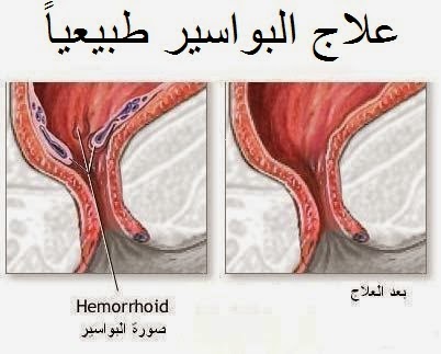 علاج البواسير في المنزل