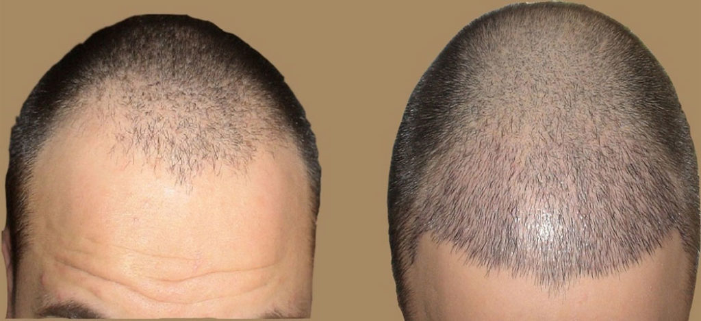 إجراء زراعة الشعر في تركيا