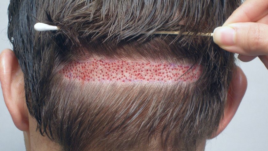 أشهر 10 مراكز لزراعة الشعر في تركيا إسطنبول 10 مراكز لزراعة الشعر