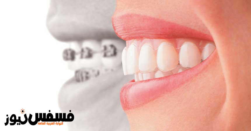 تبييض الأسنان .. أحدث فروع طب الأسنان التجميلي 10 تبييض الأسنان