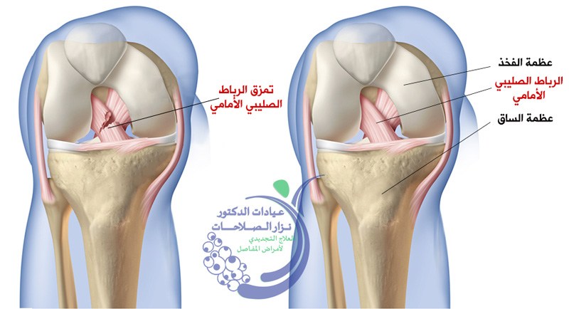 علاج قطع الرباط الصليبي الجراحي والغير جراحي 10 علاج قطع الرباط الصليبي