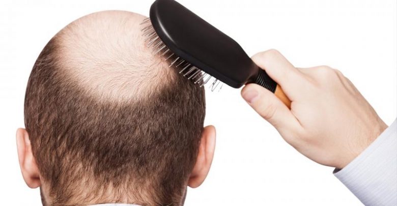 خمسة أمور يجب عليك معرفتها قبل أن تقرر زراعة الشعر 10 زراعة الشعر