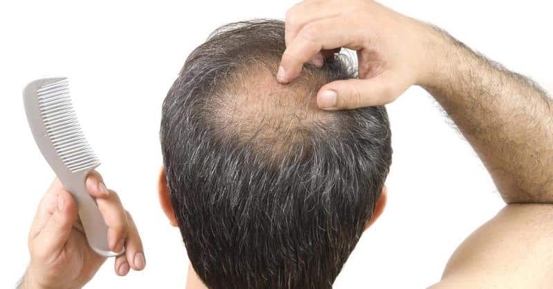 خمسة أمور يجب عليك معرفتها قبل أن تقرر زراعة الشعر 10 مشكلة ساقط الشعر