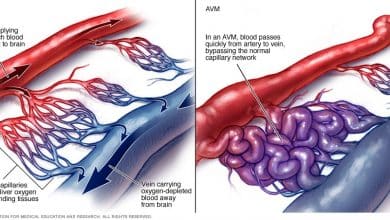 مرض AVM تشوه الشرايين الوعائية 10 مرض AVM تشوه الشرايين الوعائية 1