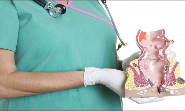 علاج البواسير بنباتات وأعشاب طبيعية 10 علاج البواسير