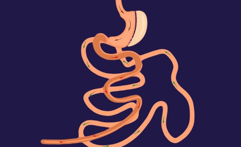 ما هي عملية الساسي للتخلص من السمنة المفرطة 10 عملية الساسي