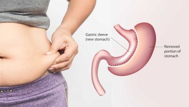 شكل البطن بعد عملية التكميم