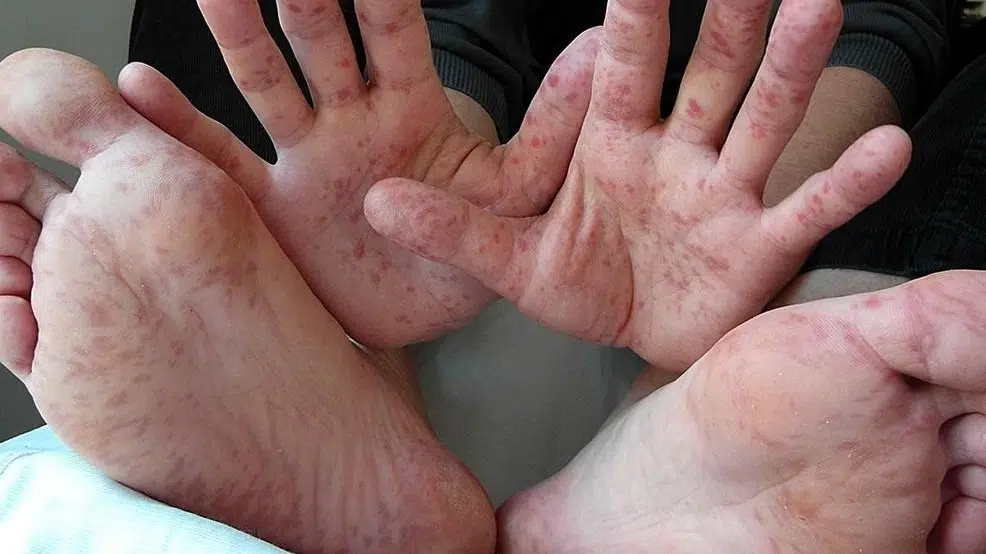 الحمى القلاعية هل تصيب الإنسان أم الحيوان؟