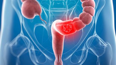 ماهي أعراض القولون العصبي